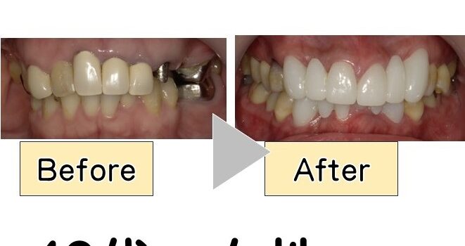 奥歯がなくて物が咬めない　　　　　　　　　　　　　　　　　４０代　女性ーインプラントー